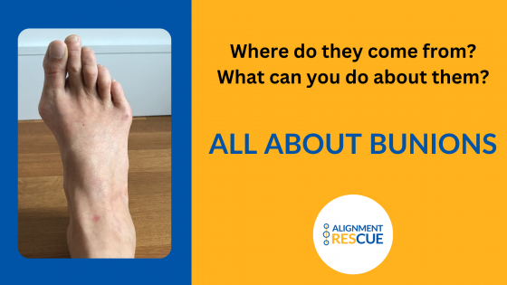 What is a Bunion? How Do You Get Bunions?
