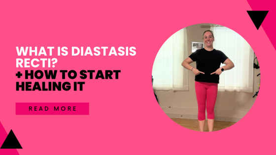 What Is Diastasis Recti? (+ How to Start Healing It)