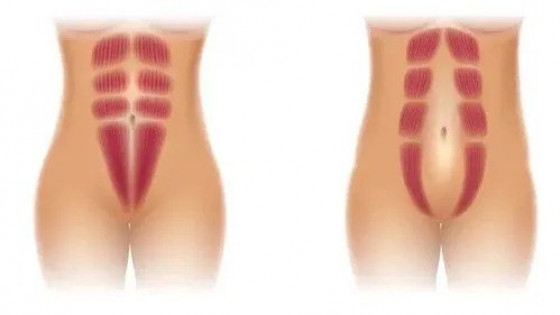 Diástasis abdominal