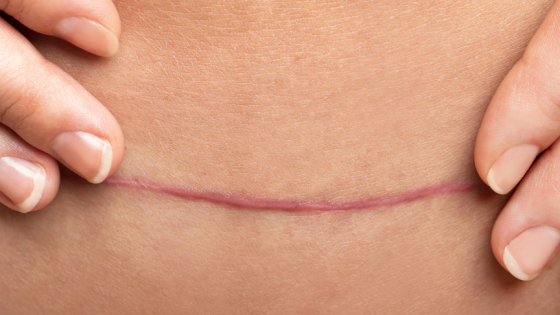 Näin tuet sektiosta toipumistasi | Äitiysfysioterapeutin vinkit