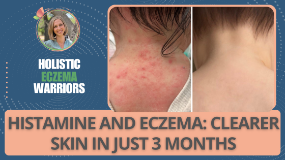Histamine and Eczema: How Ellie Cleared Her Skin in Less Than 3 Months