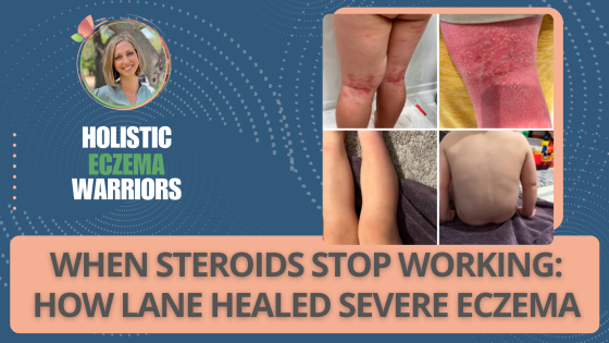 When Steroids Stop Working: How Lane Healed Severe Eczema